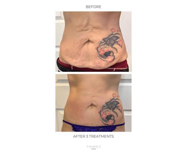 Abdomen skin tightening — before treatment and after three T-Shape treatments